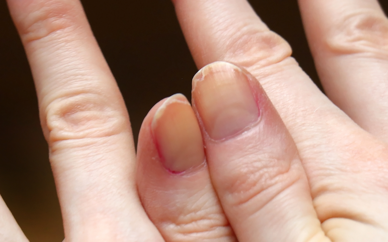 ongles de main qui se dédoublent