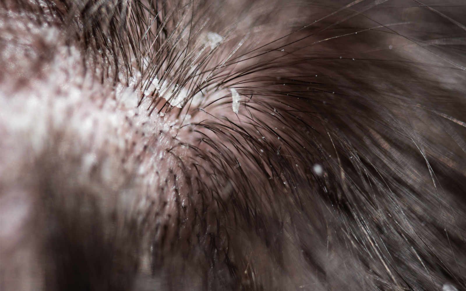 soin anti-pelliculaire cheveux giphar