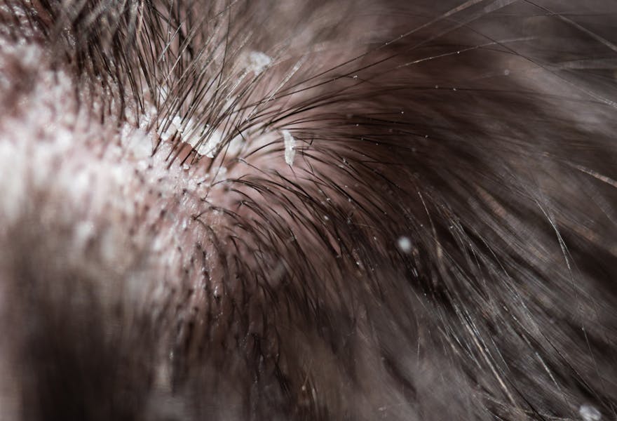 soin anti-pelliculaire cheveux giphar