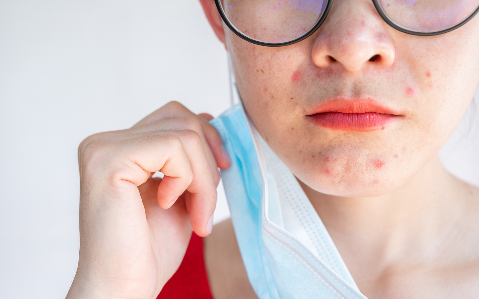 acné à cause du masque 