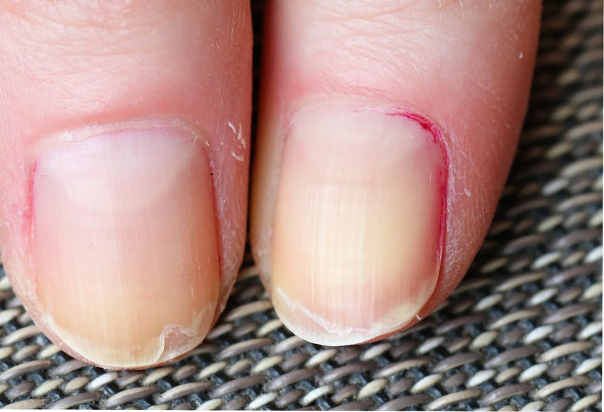 ongles qui se dédoublent giphar