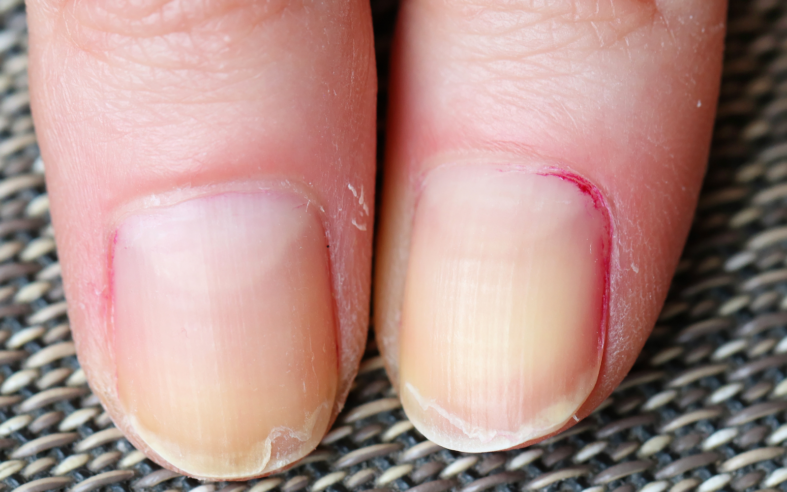 ongles qui se dédoublent giphar