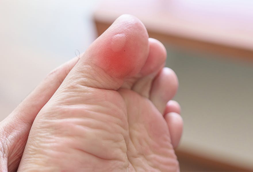 éviter les ampoules aux pieds giphar