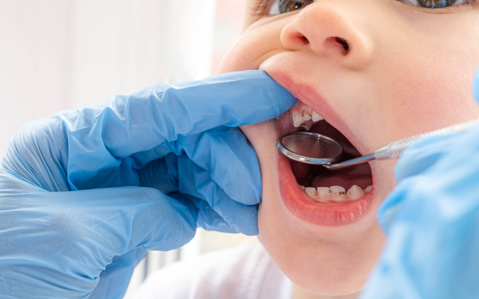 syndrome du biberon carie bébé giphar