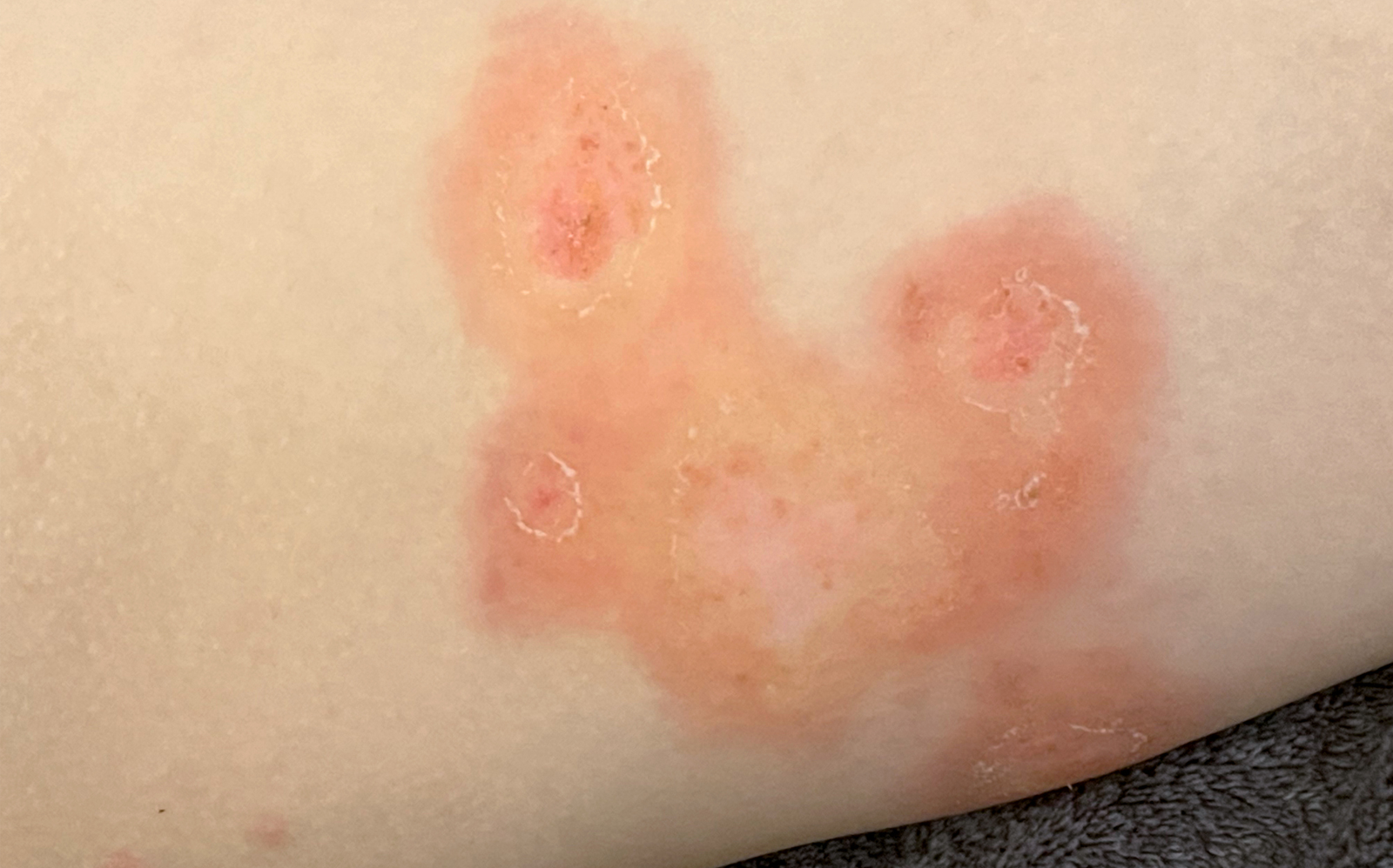 traitement impétigo