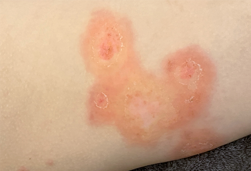 traitement impétigo