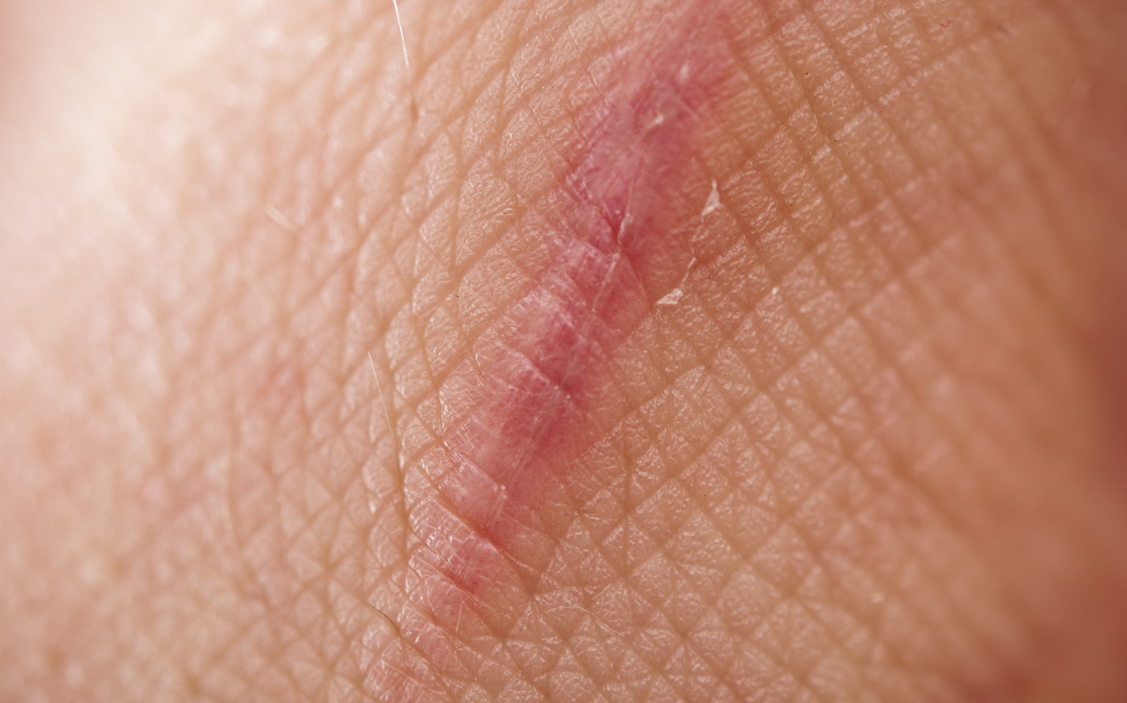 les étapes de la cicatrisation