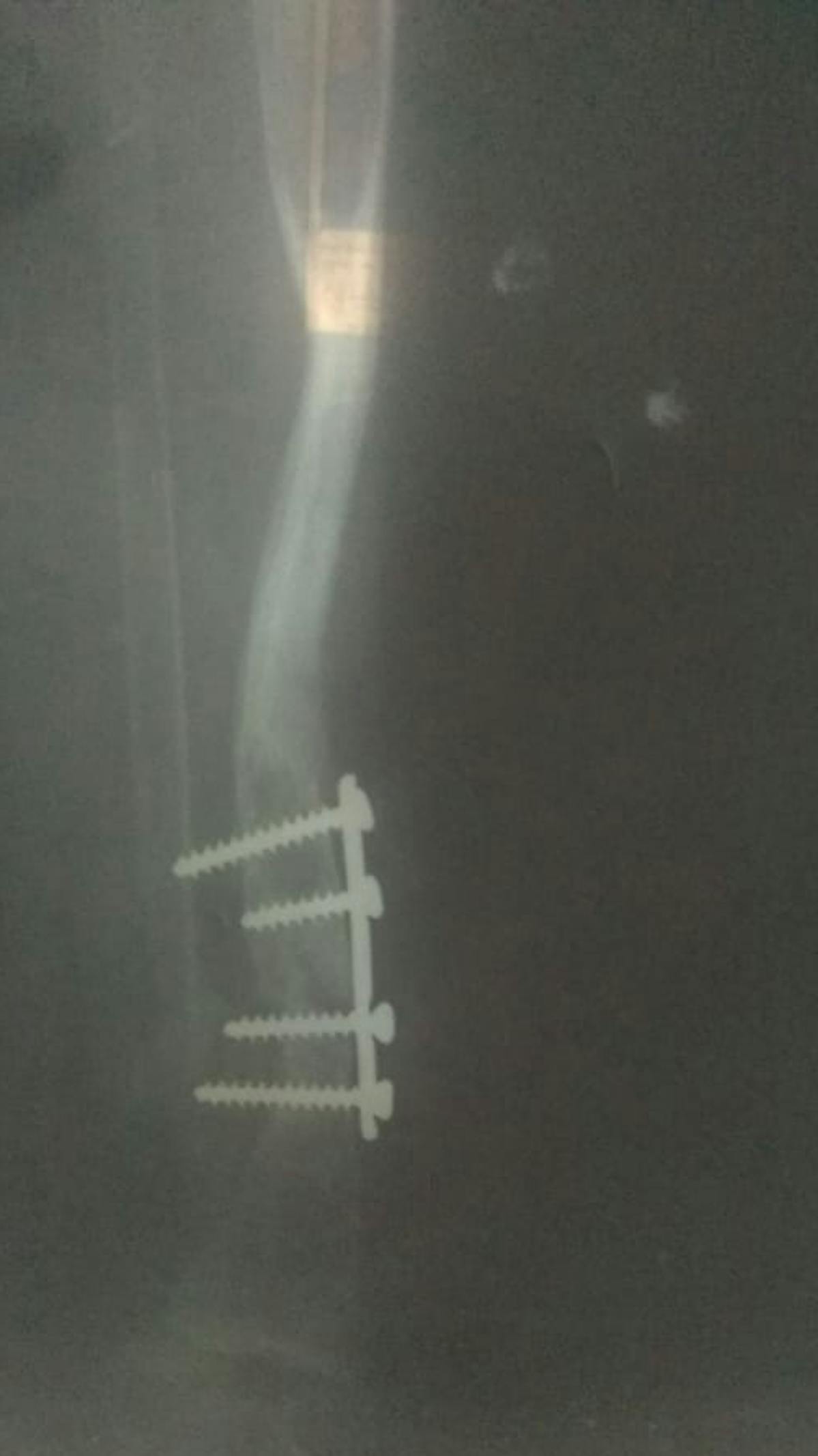 X-ray