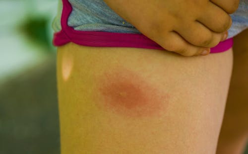 Premium Photo  Female torso with red allergic rash on stomach