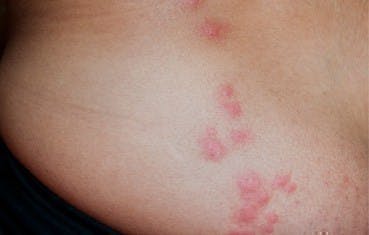 Bed Bug Bites Appearance | GoHealth