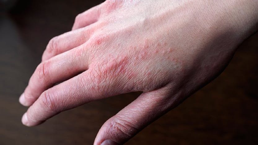 eczema rash on hands