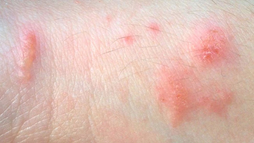 Pictures of common skin rashes, symptoms & treatments