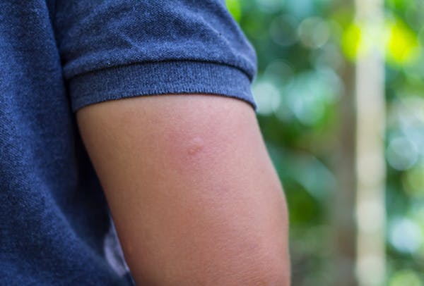 reddened skin from a mosquito bite