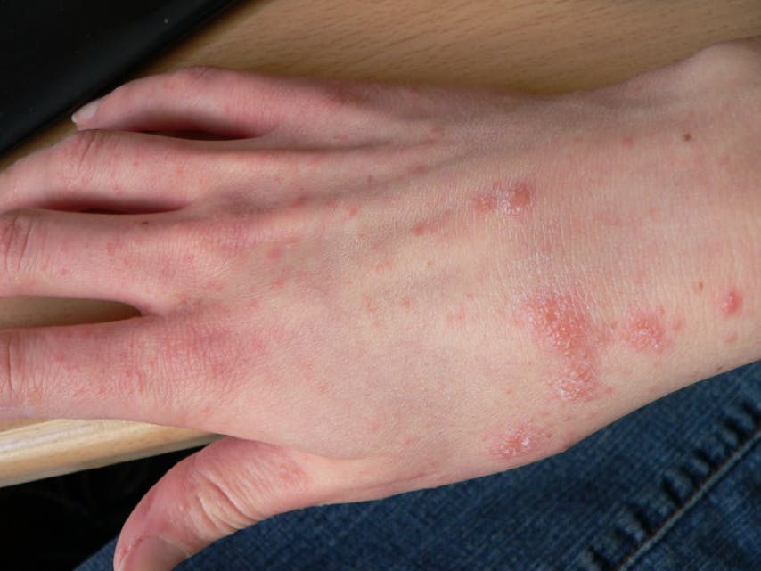 Image of Scabies rash