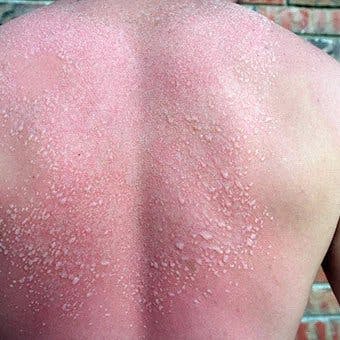 Heat rash on a man's back