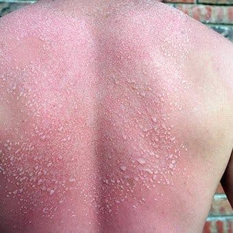 Prickly Heat Rash: Treatments, Causes, And More