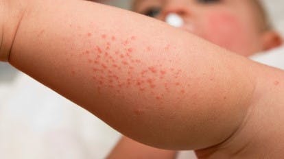 Heat Rash Treatment and Prevention