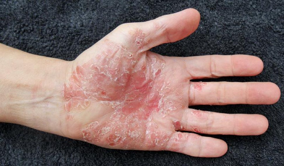 poison sumac rash on hands