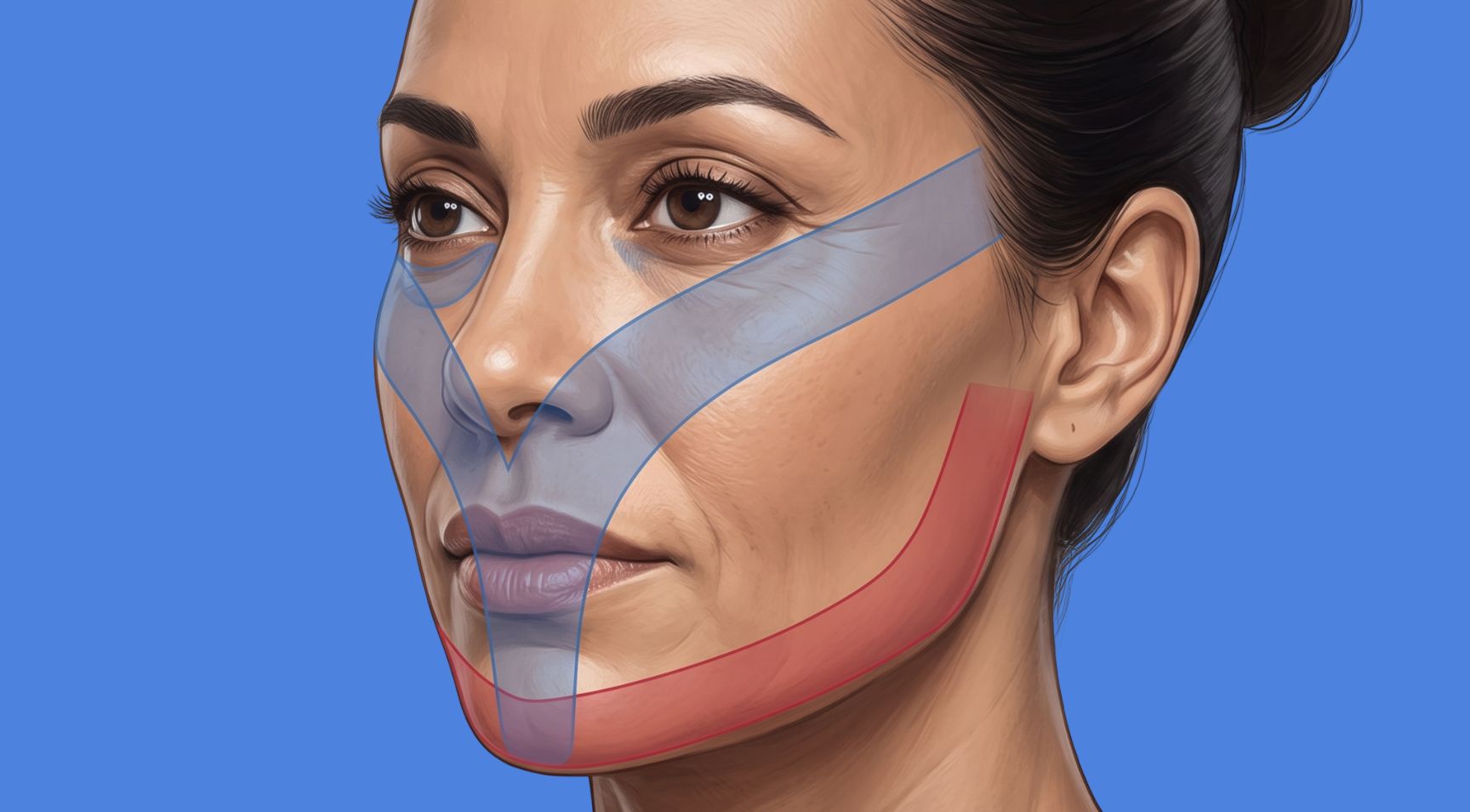 Y-zone and V-line facial anatomy for Y-Lift non surgical facelift procedure
