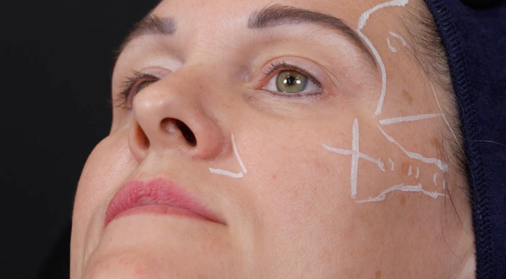 GEM© Clinic Cheek Apex Filler Injection Technique and marking up for multi-area filler treatments