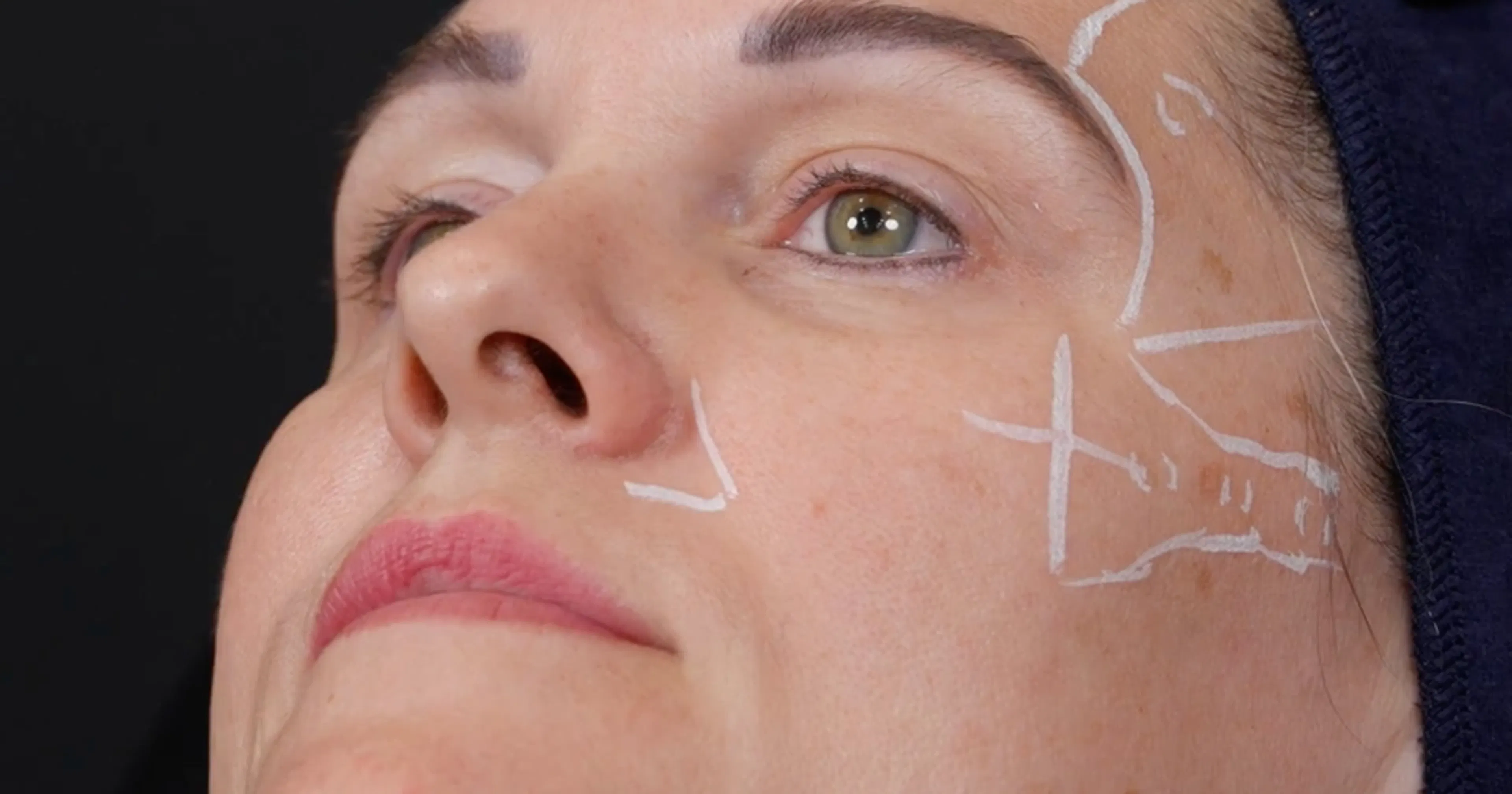 GEM© Clinic Cheek Apex Filler Injection Technique and marking up for multi-area filler treatments