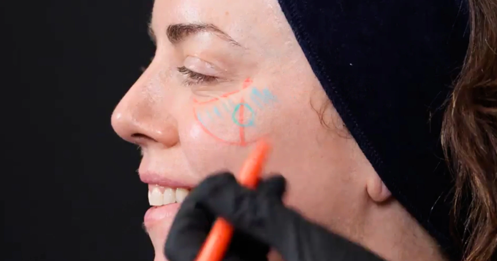 Marking up showing how to locate the cheek apex for filler treatments - Harley Academy GEM Clinic