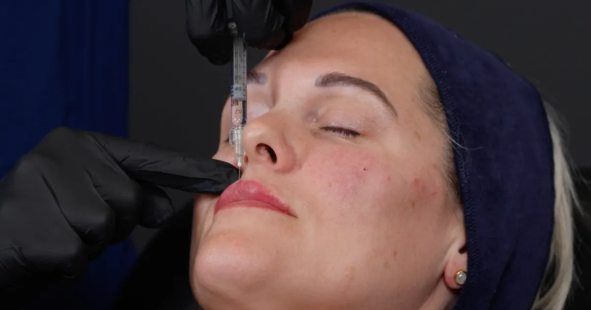 lip filler treatment using vertical threads for height a Harley Academy Global Evidence Matrix filler injection technique
