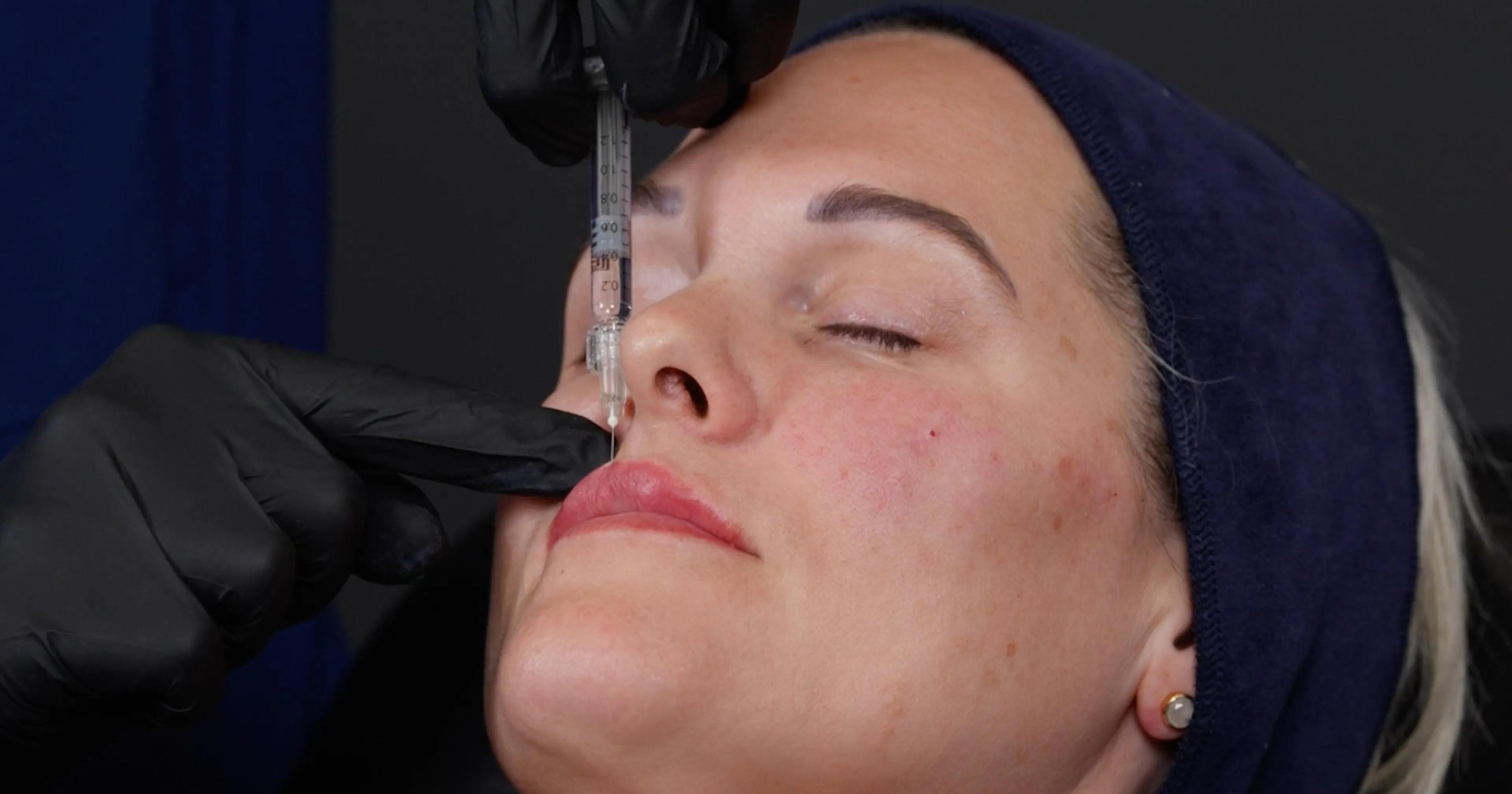lip filler treatment using vertical threads for height a Harley Academy Global Evidence Matrix filler injection technique