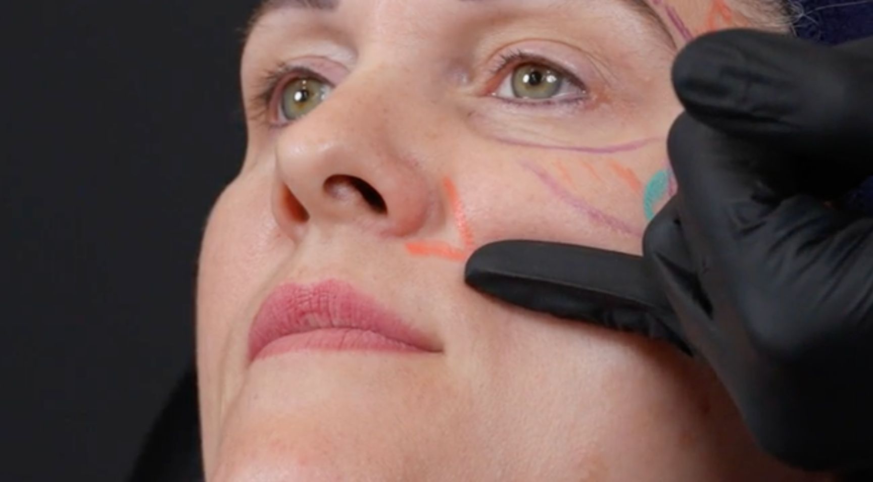 How to Treat Lip Filler Patients with Lip Blush Tattoos (semi-permanent lip makeup)