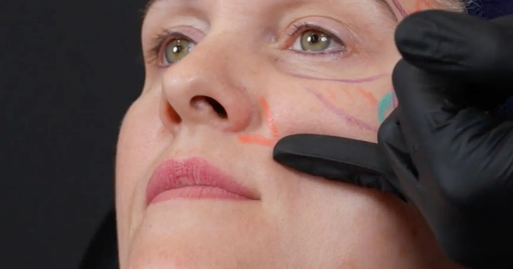 How to Treat Lip Filler Patients with Lip Blush Tattoos (semi-permanent lip makeup)