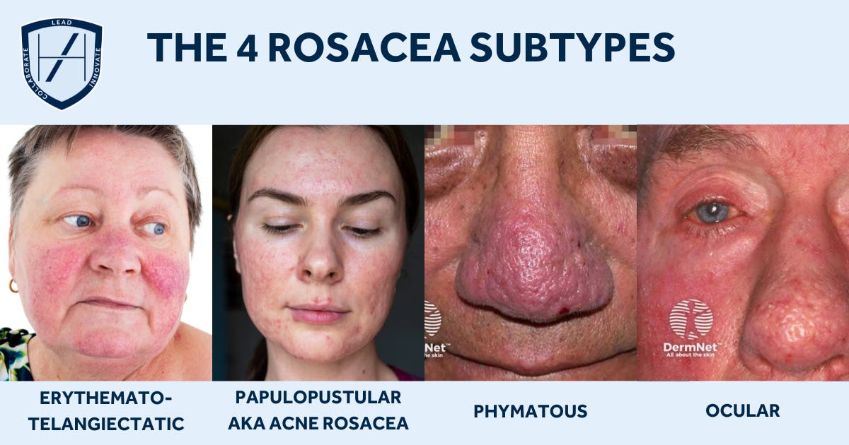 The 4 subtypes of rosacea - Harley Academy