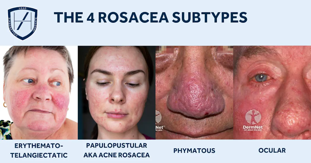 How to Identify and Treat Rosacea as an Aesthetic Practitioner