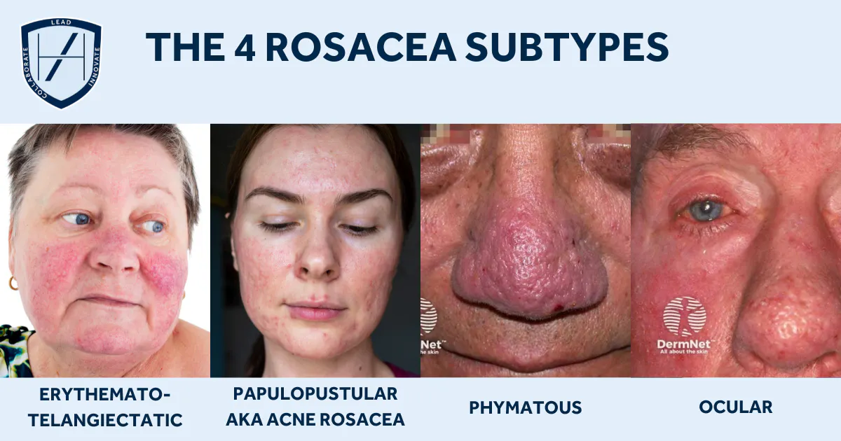 How to Identify and Treat Rosacea as an Aesthetic Practitioner