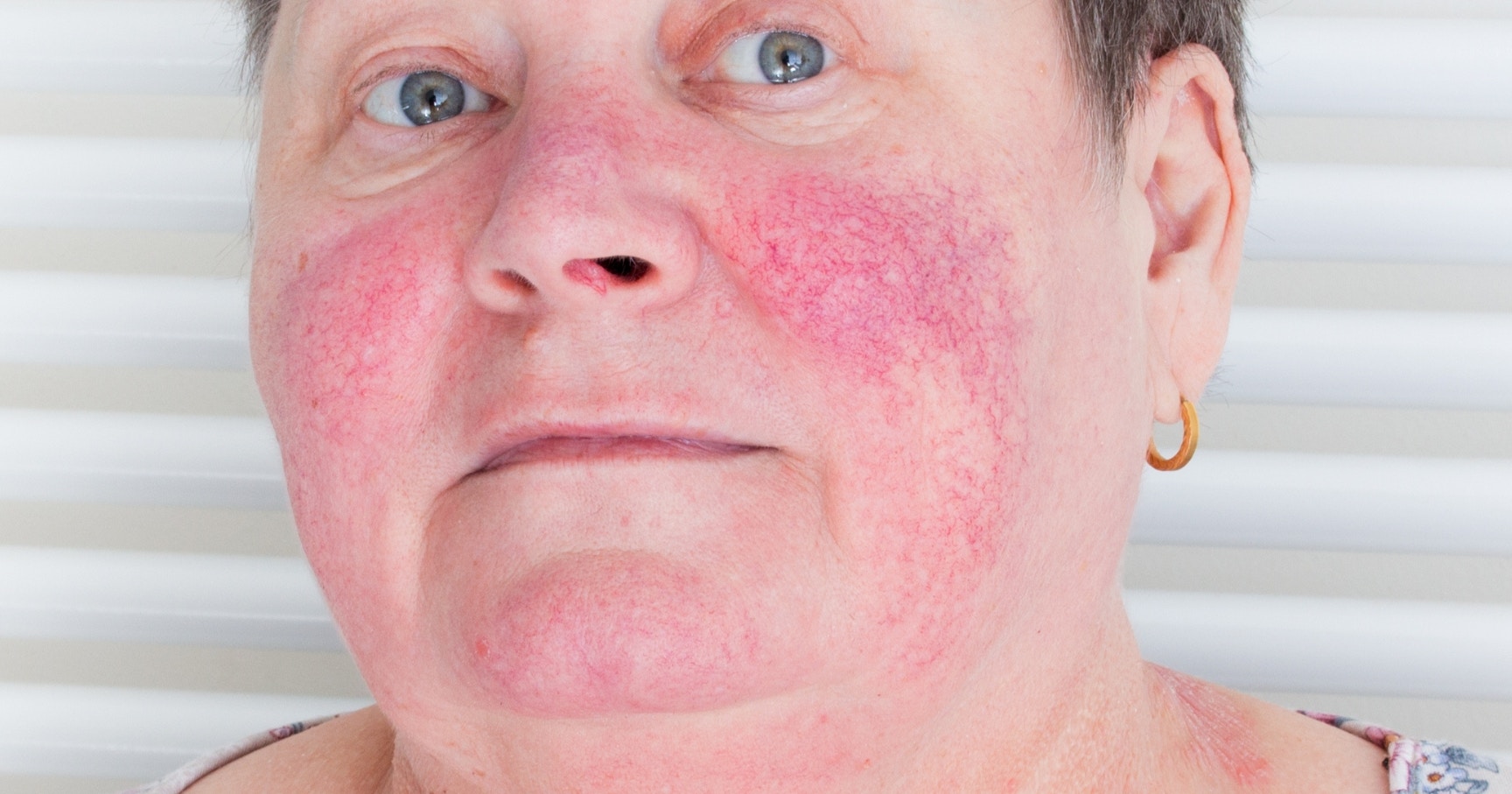 How to treat rosacea as an aesthetic practitioner