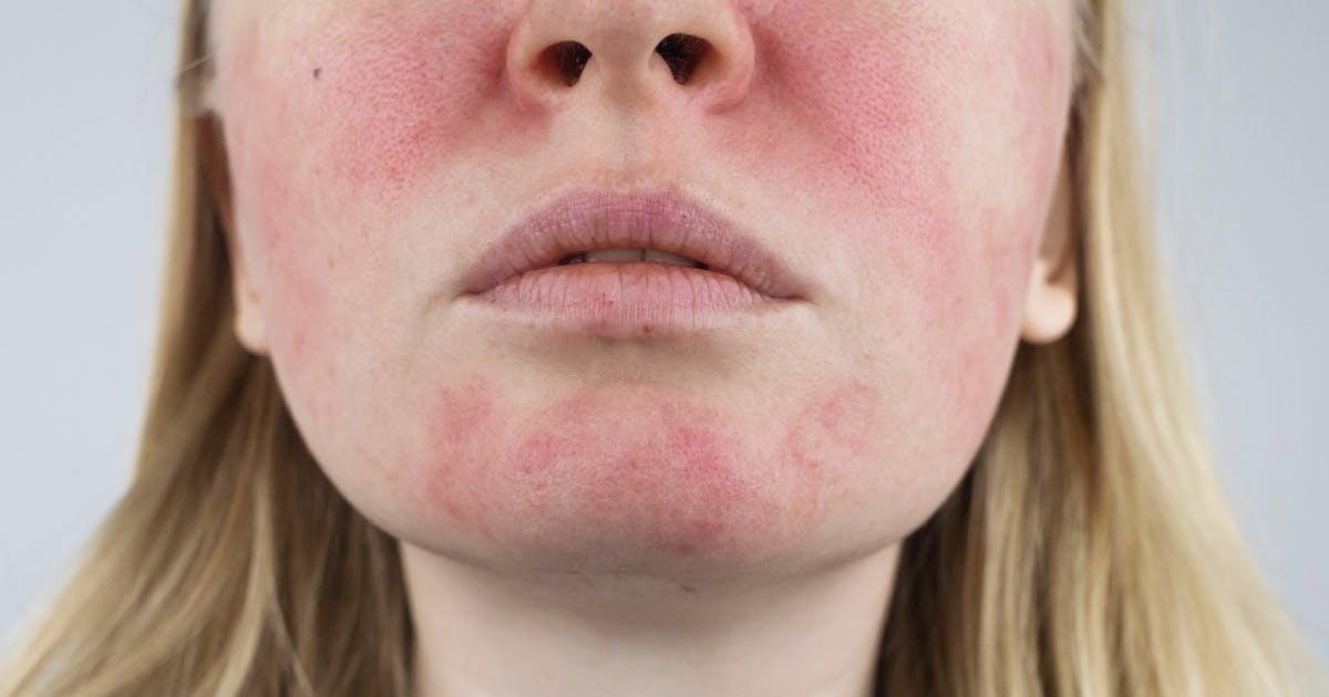 Example of rosacea