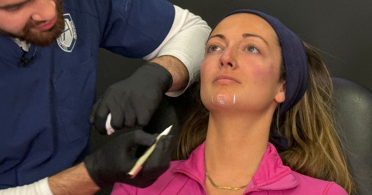Marking up for chin filler at Harley Academy