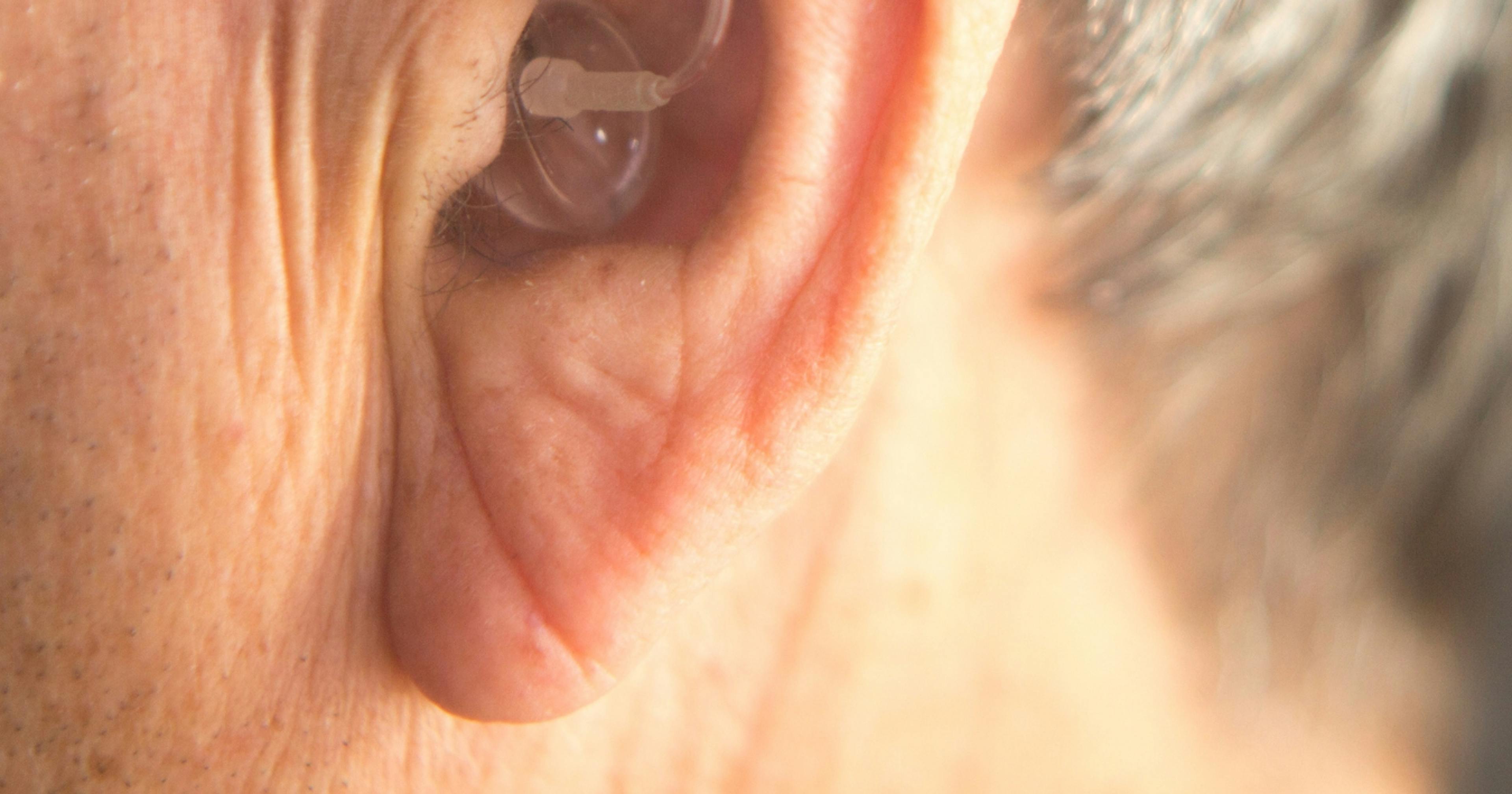 Earlobe filler for rejuvenation - Harley Academy