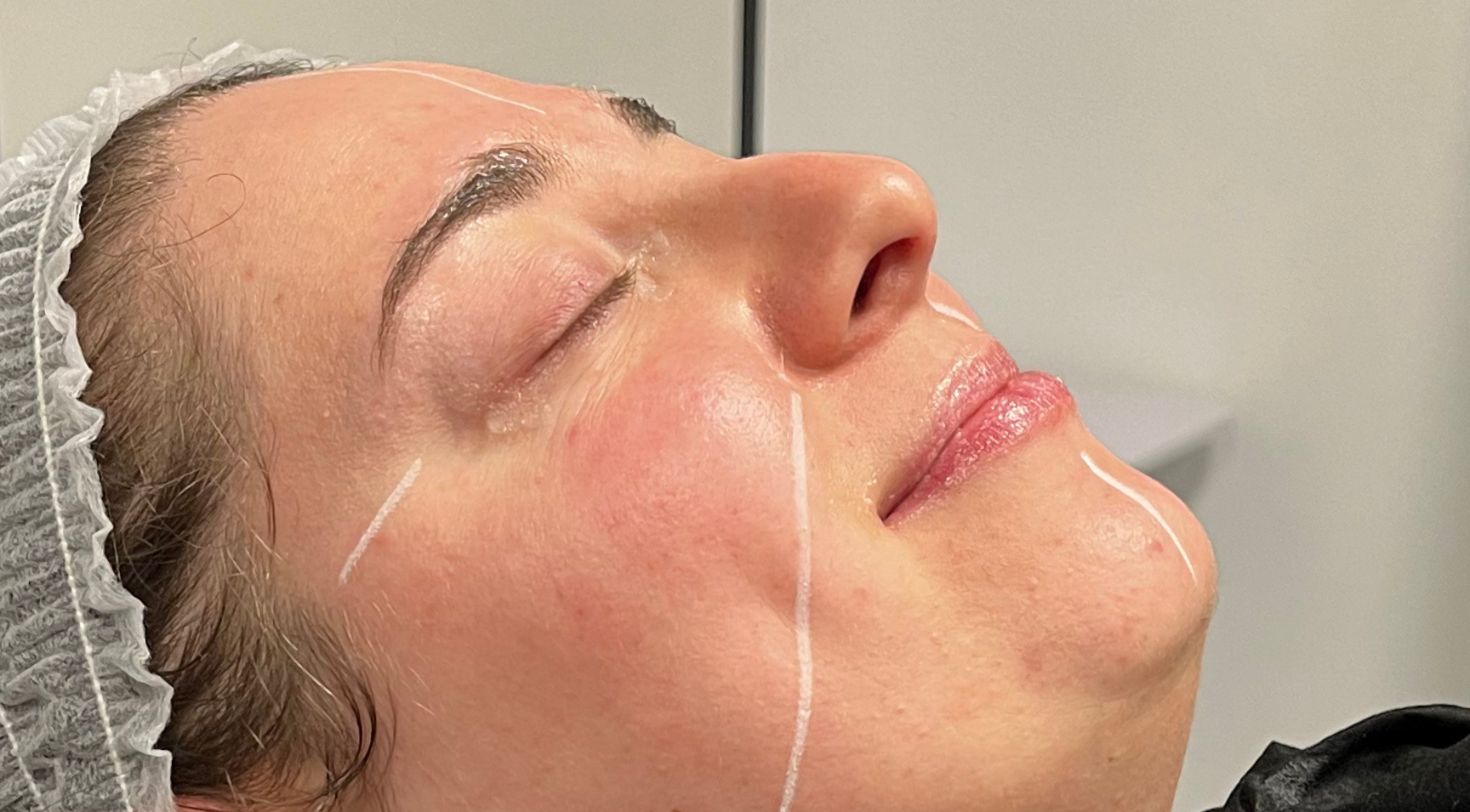 Chemical Peel course at Harley Academy Cosmetic Dermatology Training