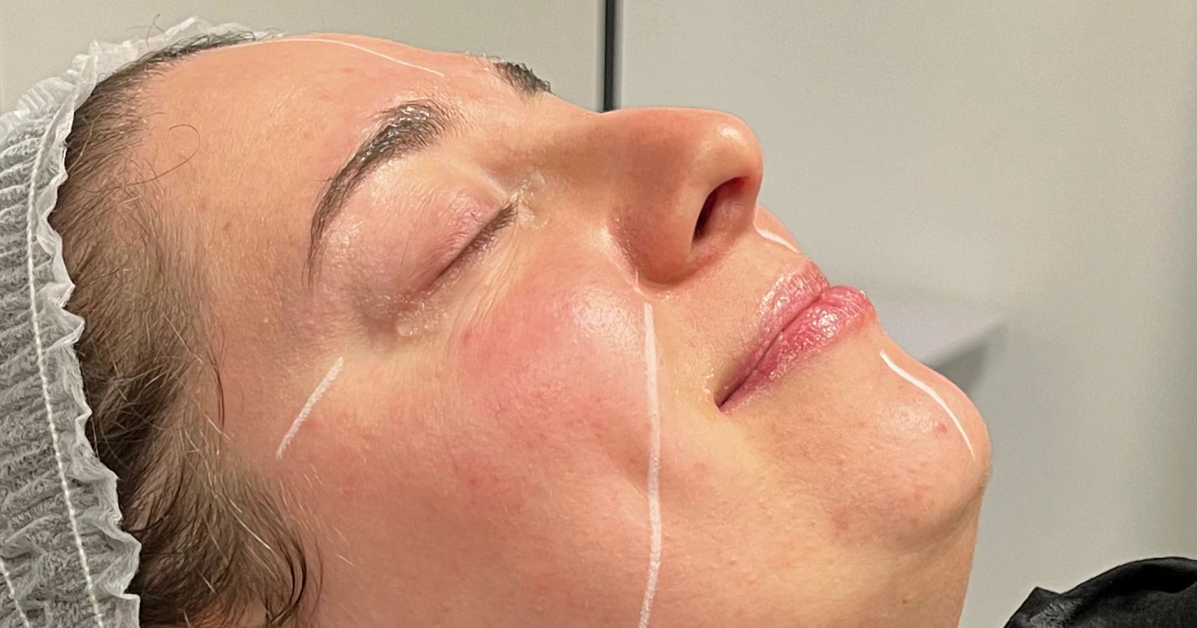 Chemical Peel course at Harley Academy Cosmetic Dermatology Training