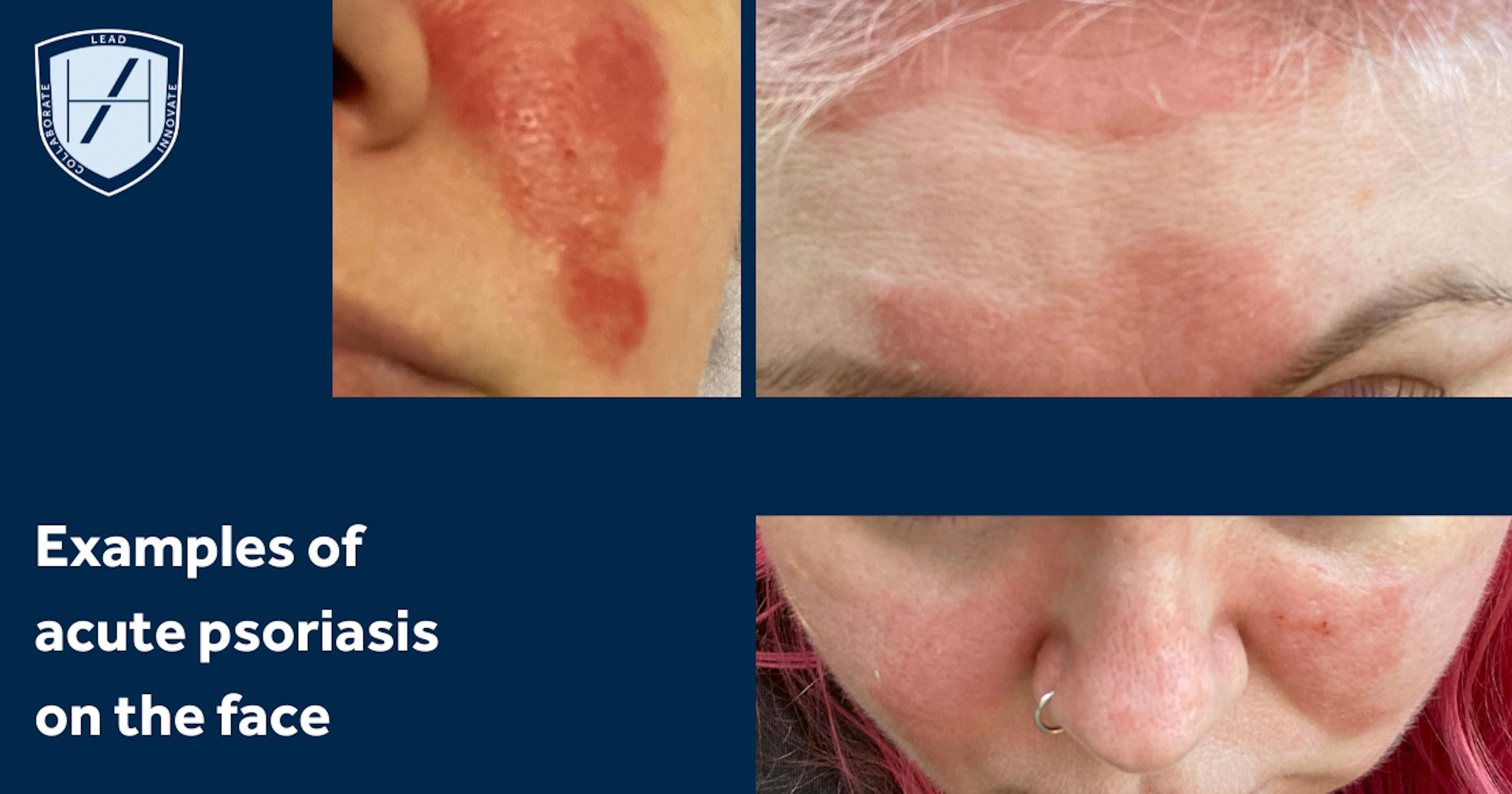 Examples of acute facial psoriasis