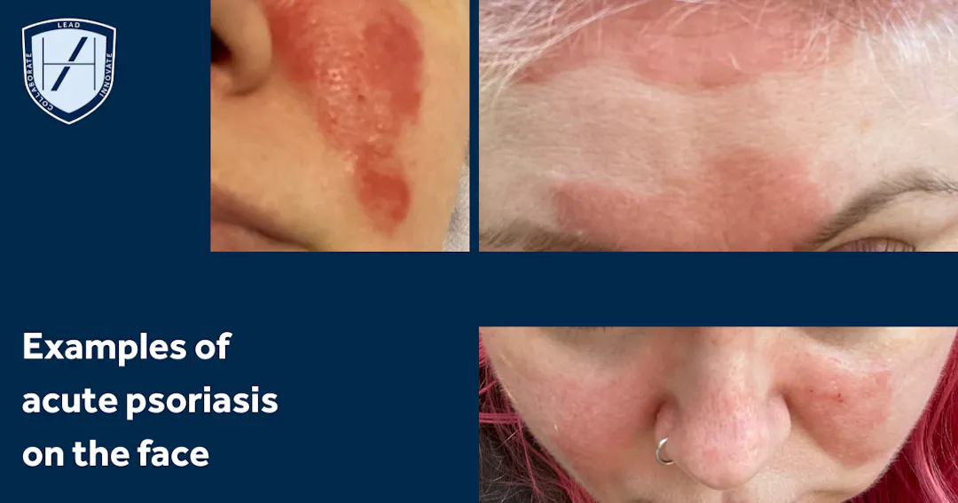 Koebner Phenomenon: What Aesthetics Practitioners Need to Know