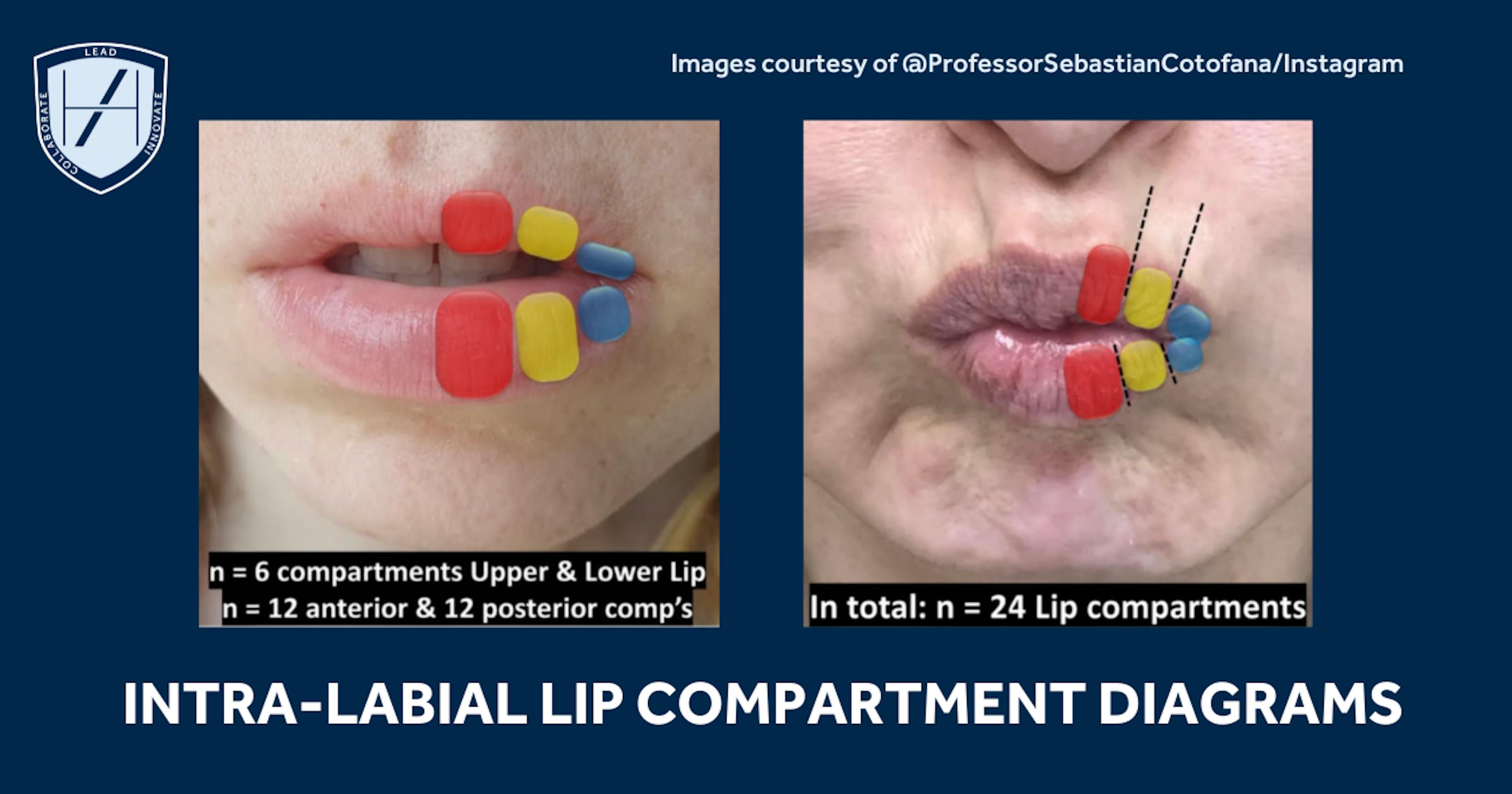 Intra-labial lip compartments diagrams