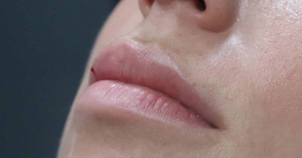 Lip filler half way through treatment - lip injections course