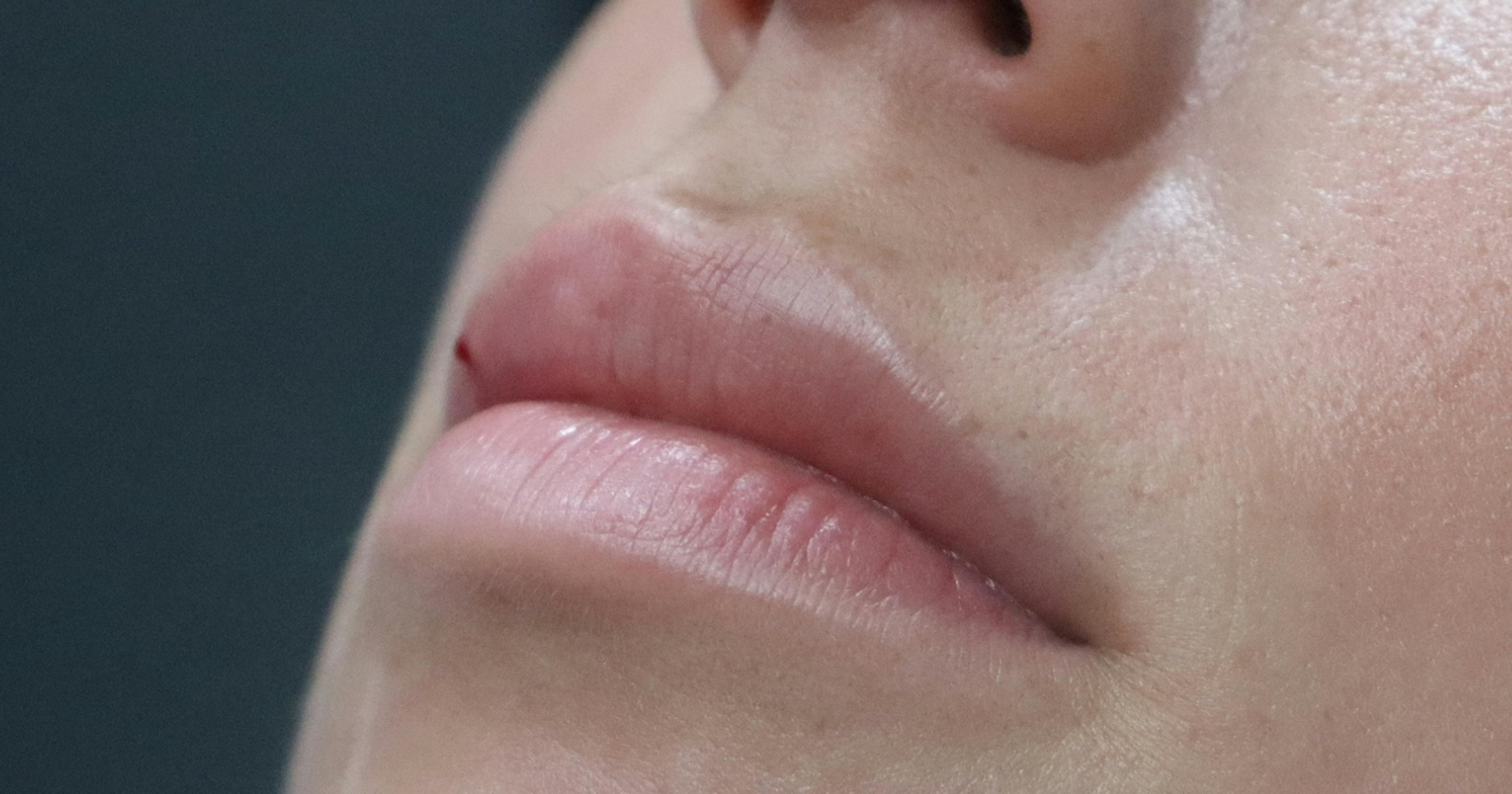 Lip filler half way through treatment - lip injections course