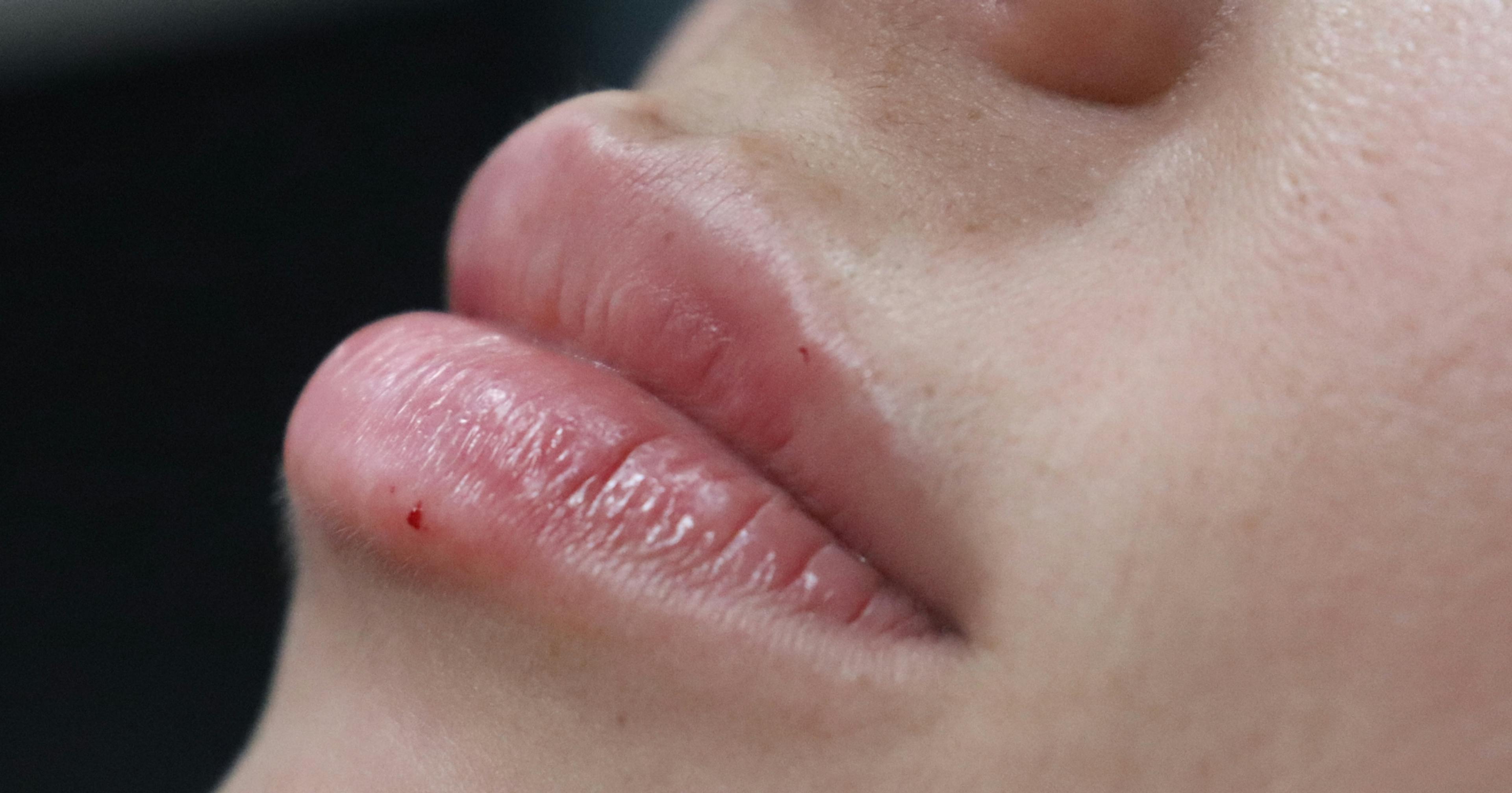 lip filler courses near me
