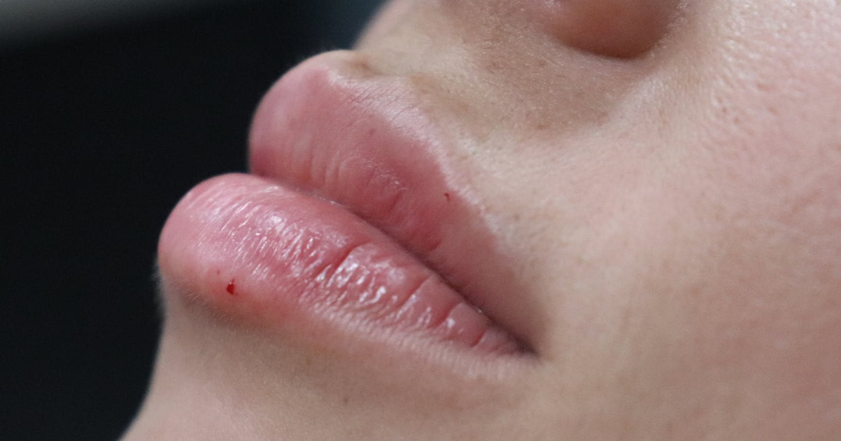 lip filler courses near me