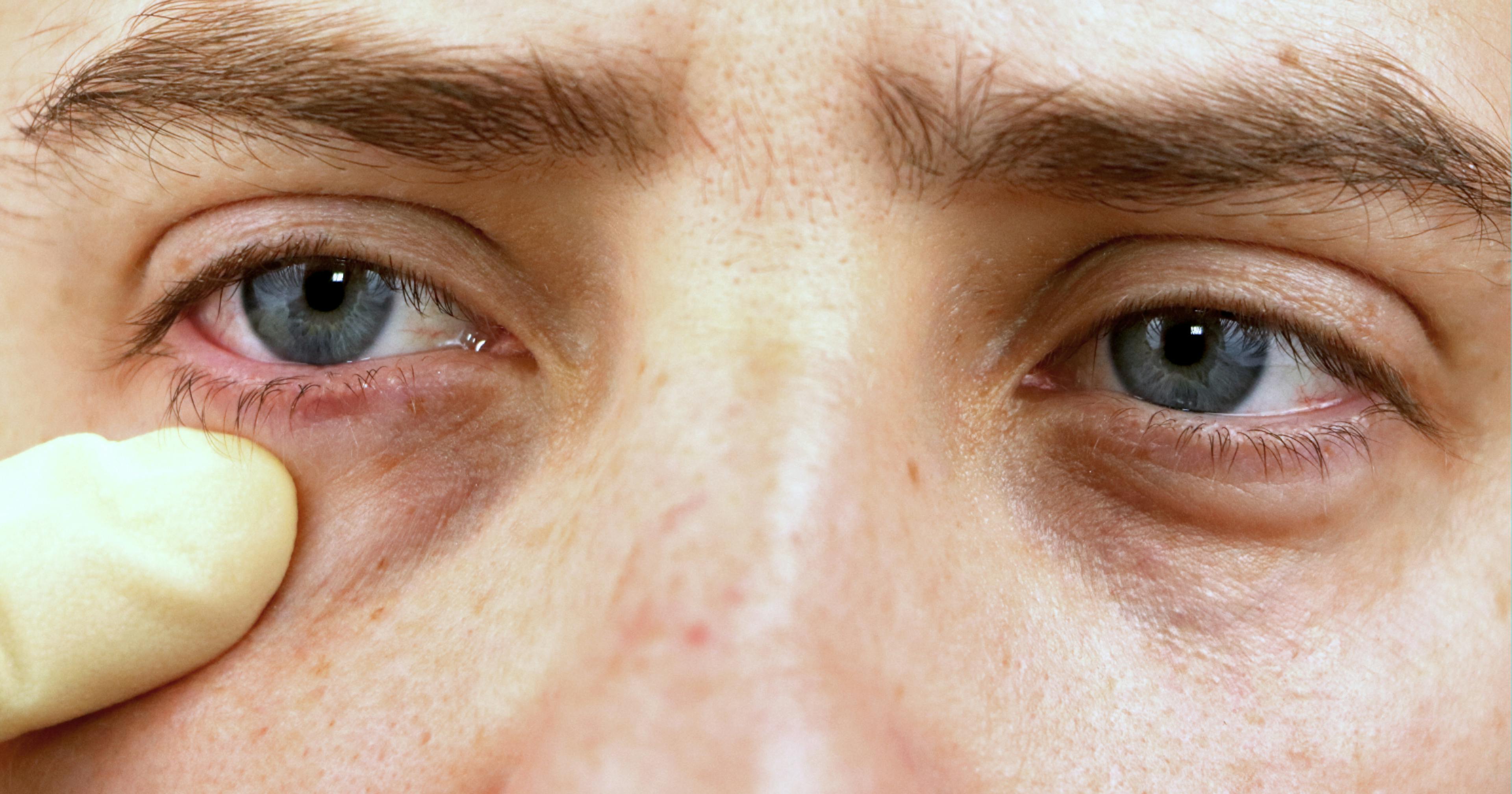 How to treat dark circles with polynucleotides 