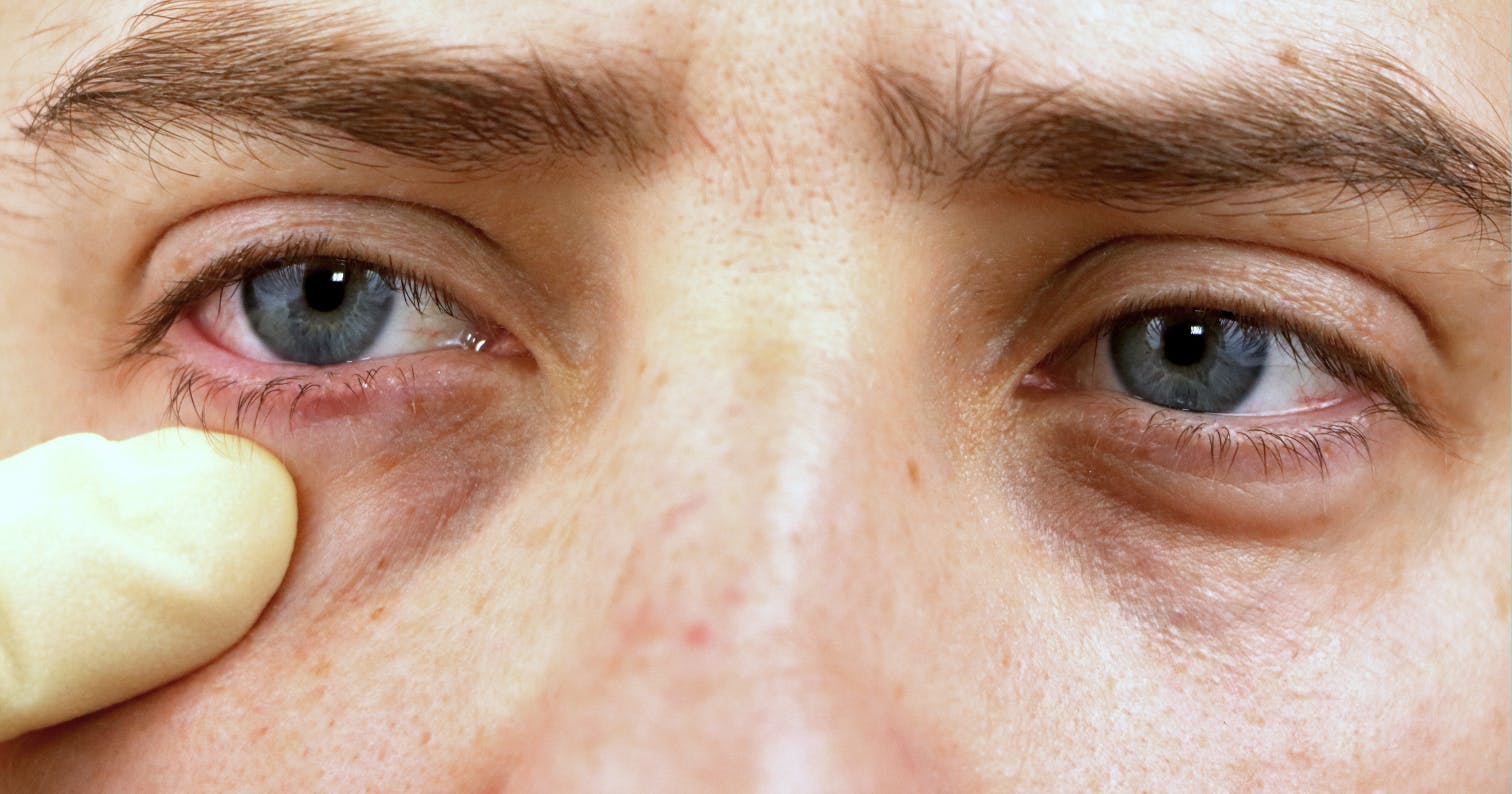 How to treat dark circles with polynucleotides