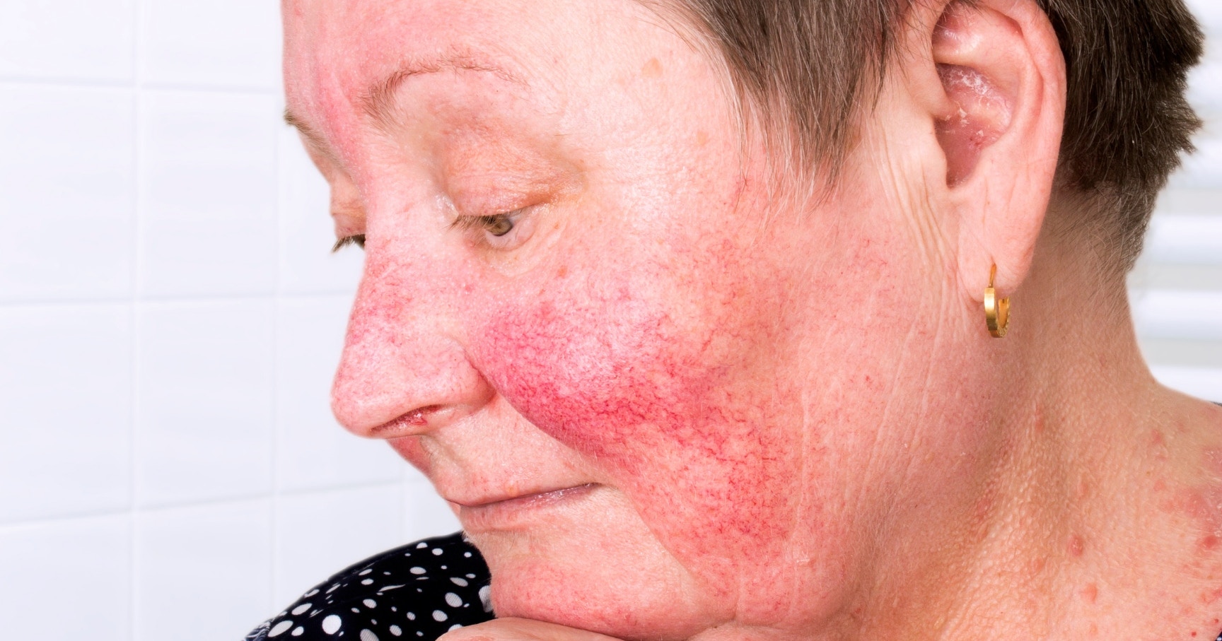 Rosacea and rejuvenation treatment planning case study exercise
