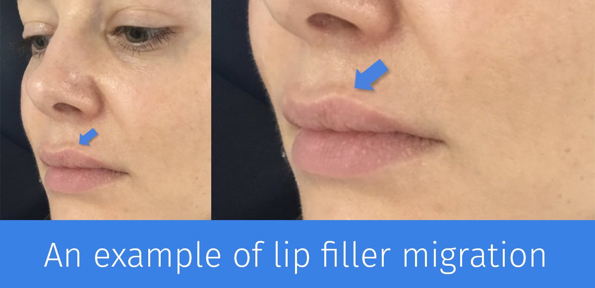 shelf like lip filler migration presentation